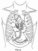 Artery Coronary Tunneling sketch template