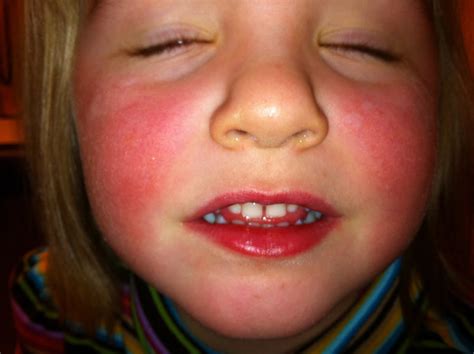 toddler facial rashes pictures