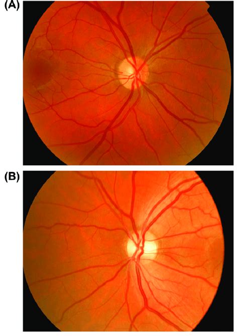 fundoscopy showing band atrophy   left eye   normal optic
