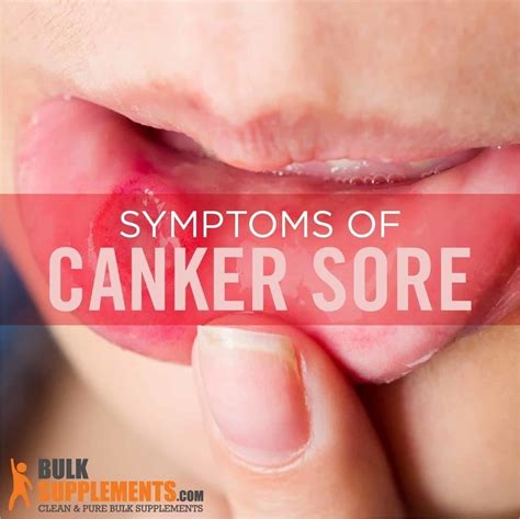 tablo read canker sores symptoms   treatment