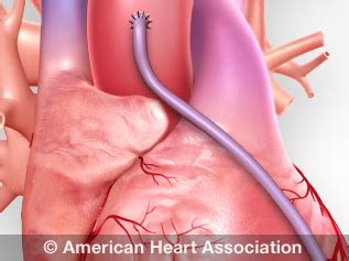 heart procedures  surgeries american heart association