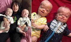 pfeiffer syndrome ideas syndrome genetic disorders genetics