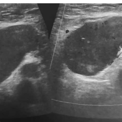 Ultrasound Of Right Axilla Enlarged Malignant Looking Lymph Nodes In