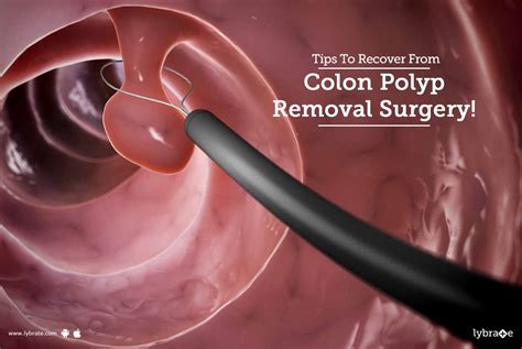 tips  recover  colon polyp removal surgery  dr avaneesh