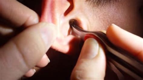 remove impacted earwax specialists remove huge piece  earwax  mans ear huffpost