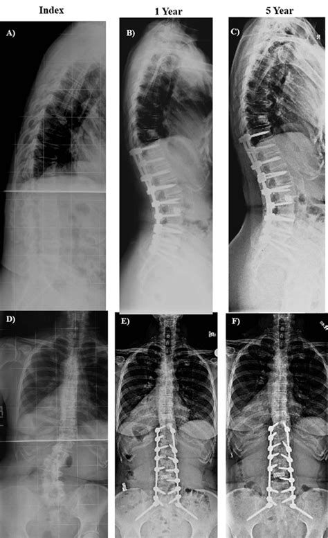 The Effect Of Prophylactic Vertebroplasty On The Incidence Of Proximal