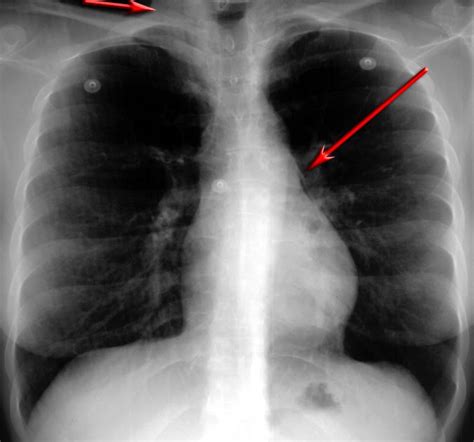 radiologyspirit bronchial asthma