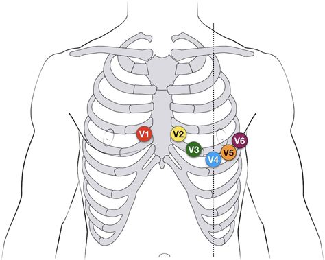 ecg lead positioning litfl ecg library basics