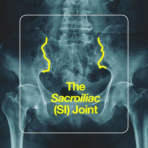 joint pain   identify relieve sacroiliac joint pain