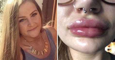 Woman Is Told Blowjobs Are To Blame For Filler Leaking From Her Lips