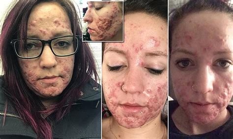 manitoba woman shares her battle against severe acne daily mail online