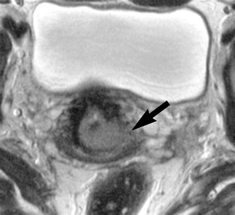 mr imaging of cervical carcinoma a practical staging approach