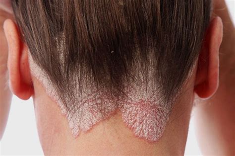 Seborrheic Dermatitis From Diagnosis To Treatment Novosilska Clinic