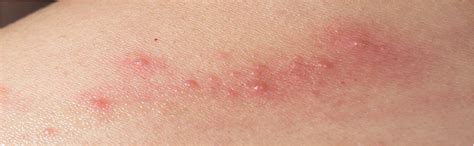 removing acne scars on sensitive skin dermatix® asia
