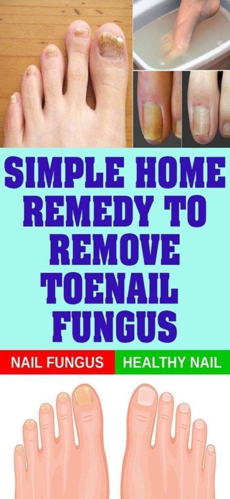 simple home remedy  remove toenail fungus toenail fungus remedies