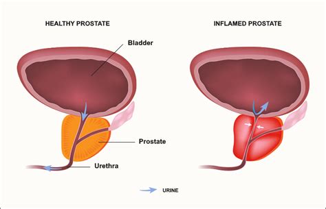 prostate symptoms diagnosis treatment regen50 nutrilago®