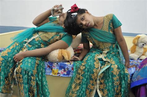 Conjoined Twins Warning Graphic Images Bilder