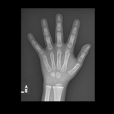 Wrist X Rays Laptrinhx News