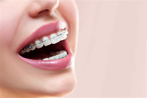 close  open mouth  ceramic  metal braces  beautiful teeth