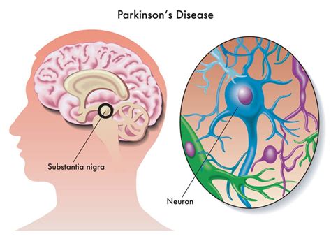facts  parkinsons disease  stem cell therapy advancells