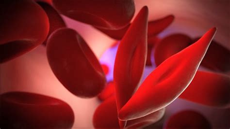 gene therapy  sickle cell disease latest research