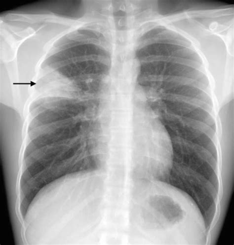 Fig 1 6 [subsegmental Right Upper Lobe Pneumonia ] Diseases Of