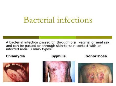 Chlamydia Bacterial Infection What Is Genital Herpes Simplex 2