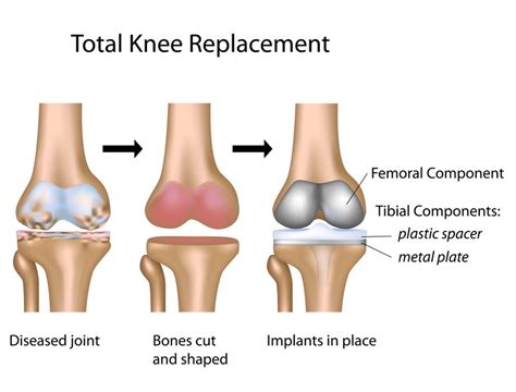 knee replacement auckland orthopaedicsauckland orthopaedics