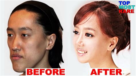 50 Korean Plastic Surgery Before And After Photos Youtube