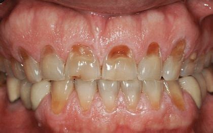 stop grinding teeth  sleep bruxism definition treatment