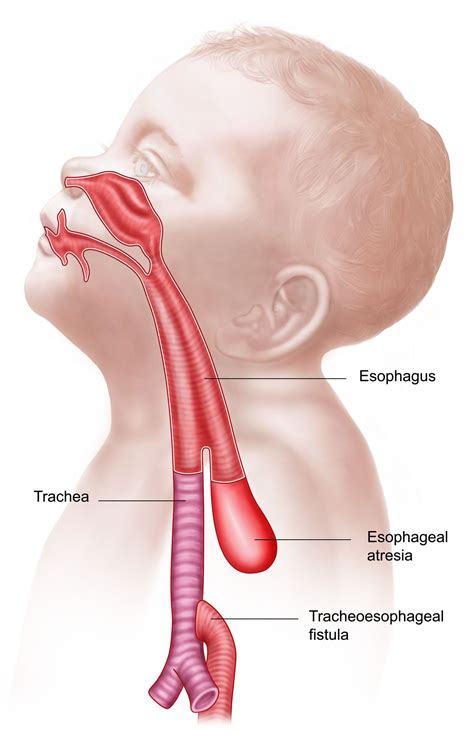 Esophageal Atresia Overview And More