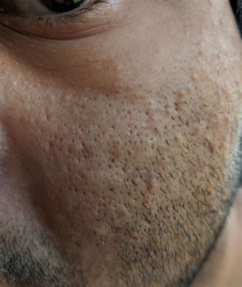 skin concerns     rid   holes   face ive     life