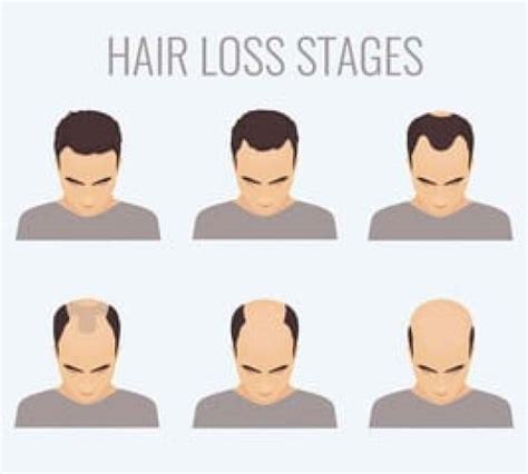 types  hair loss valuable   advice   bald guy beard
