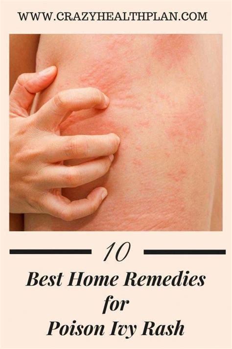 what is the best remedy naturalremediesforwomen shealth poison ivy