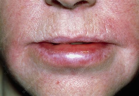 angioedema of lips in hindi