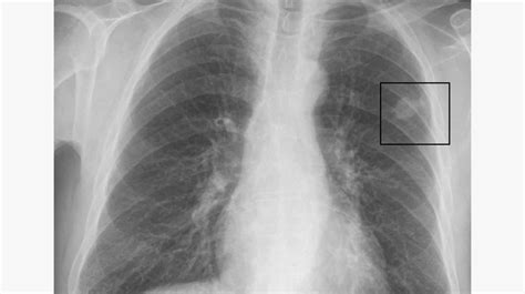 lung nodule size chart   size  nodules