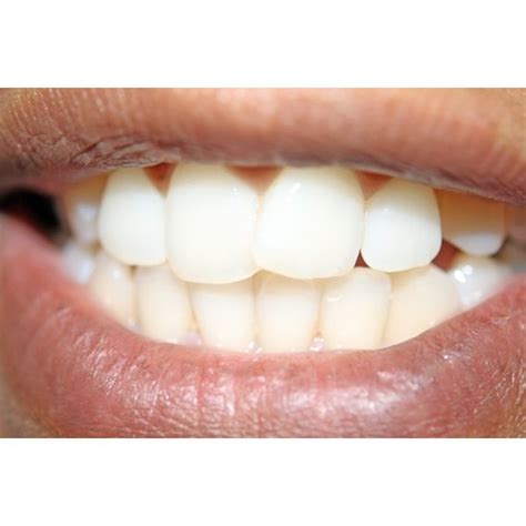 What Do Black Spots On Gums Mean Healthfully