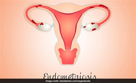 What Is Endometriosis Causes Symptoms And Treatment Tips