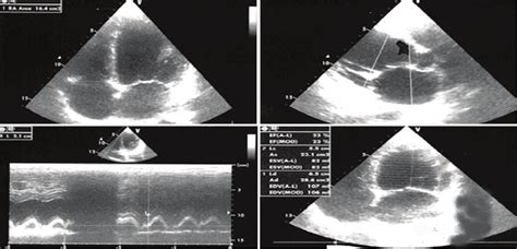 transthoracic echocardiography tte   patients  visit