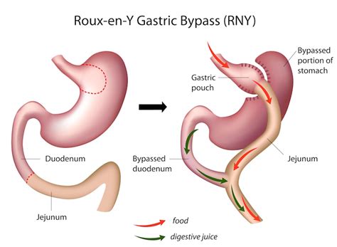 Roux En Y Gastric Bypass Rygb Facts Risks And Costs