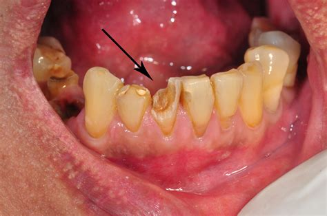 Case 3 Aesthetic Fillings With Resin Composite Prestige