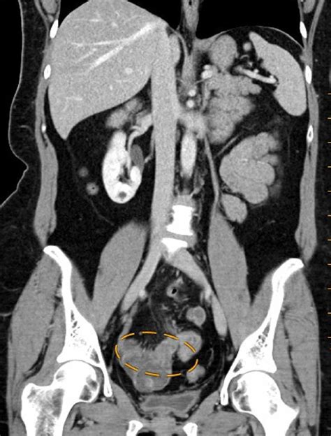 cureus endometriosis of the vermiform appendix presenting as acute