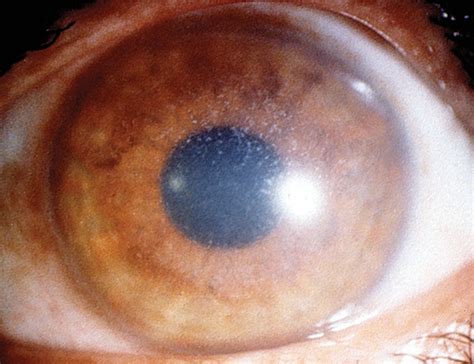 unusual superficial variant  granular corneal dystrophy  amyloid