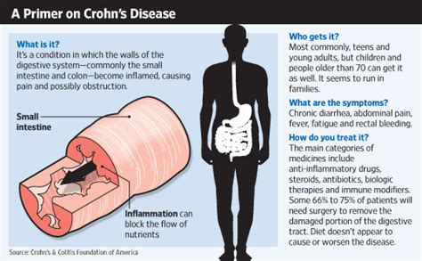 In The Lab New Hope For Crohn S Sufferers Wsj
