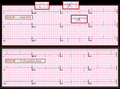 dr smiths ecg blog chest pain   waves
