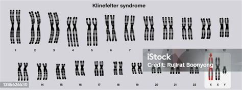 Karyotype Của Người Của Hội Chứng Klinefelter Klinefelters Ks Hoặc Xxy