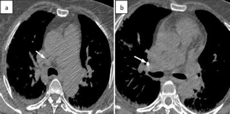 A And B Axial View Of Ct Thorax In Mediastinal Window Shows Few