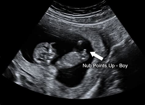 Gender Scan Diagnostic Ultrasound