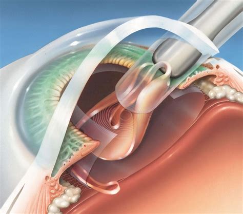 day  cataract surgery eye care  ophthalmologists eye surgeons
