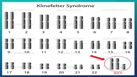 Klinefelters Syndrome Screen 2 On Flowvella Presentation Software